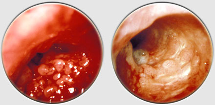 Dr. Diag - Papillomatosis respiratorica reccurentis