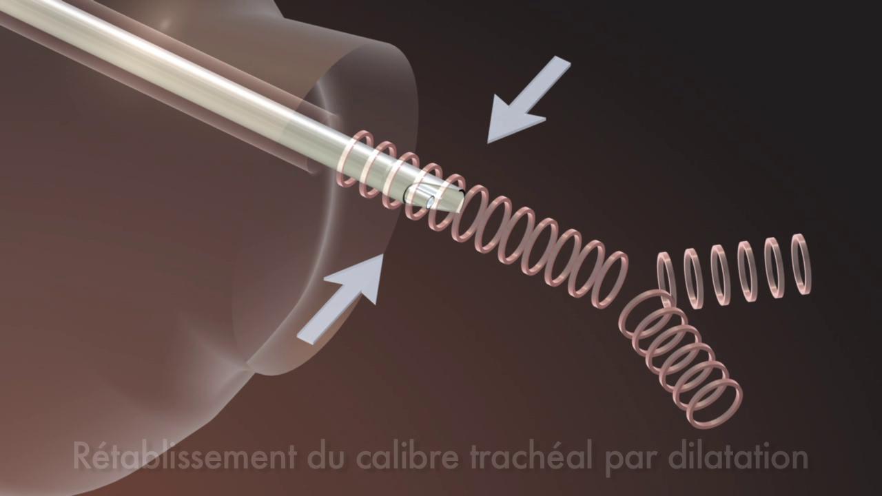 Rétablissement du calibre trachéal par dilatation