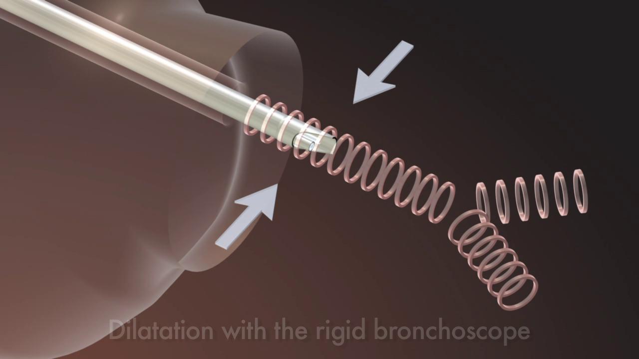 Dilatation with the rigid bronchoscope
