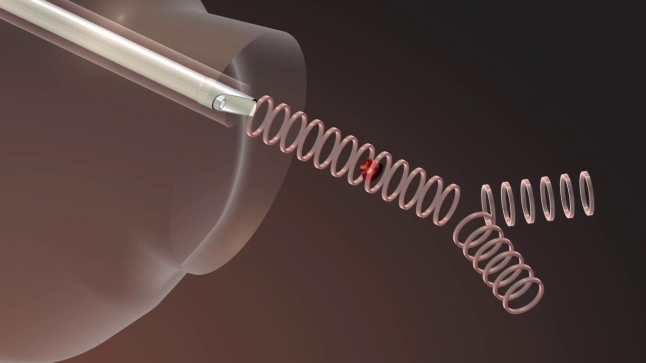 Endoscopic Resection