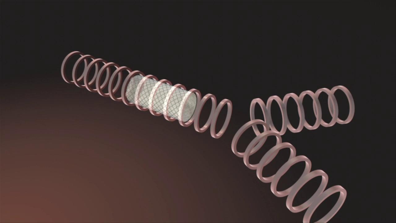 Metallic stents