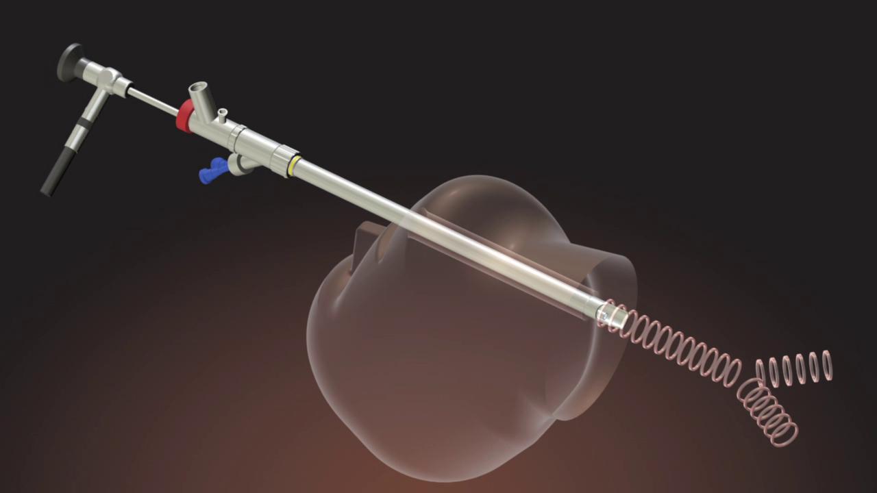Tracheal stent placement