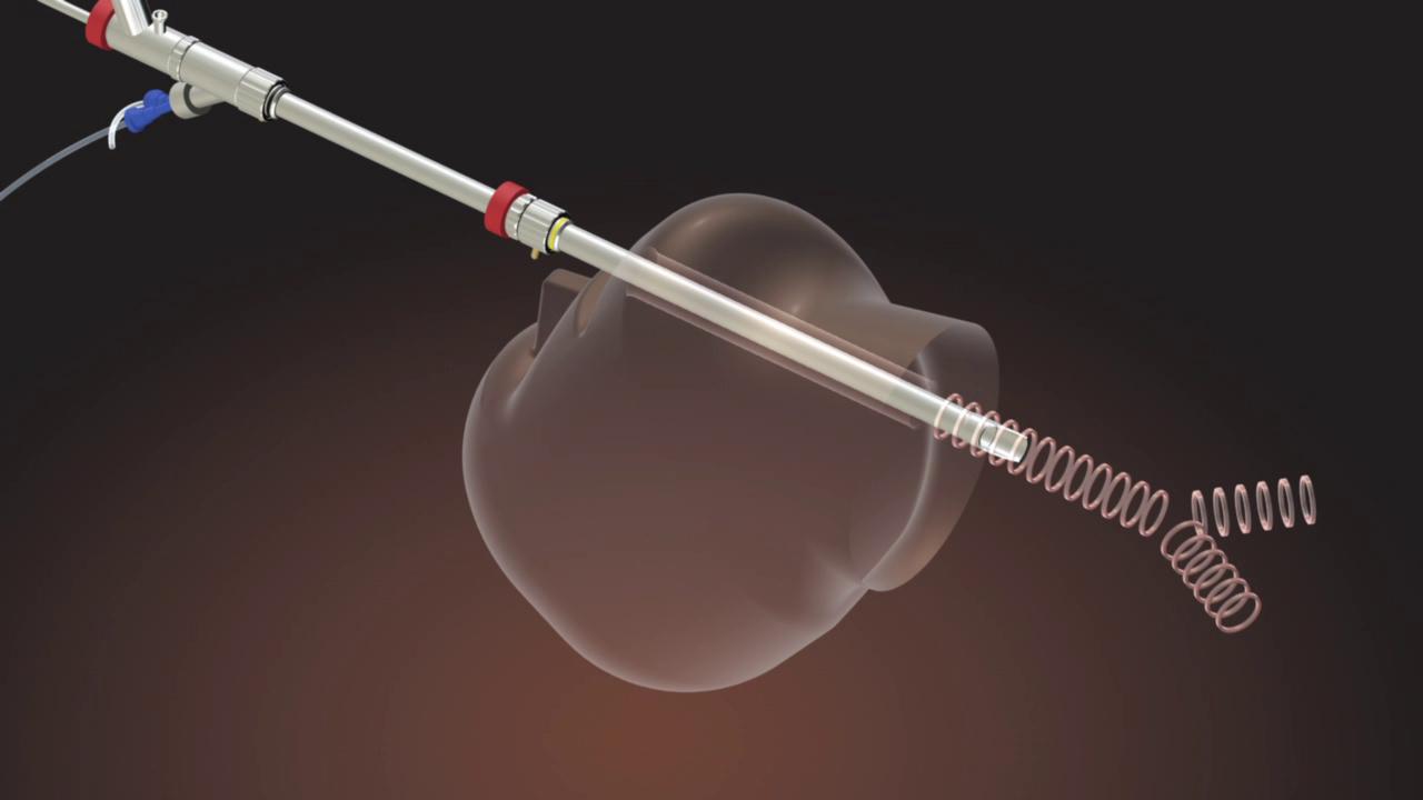 Using the rigid bronchoscope